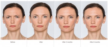 BOTOX (Botulinum toxin)